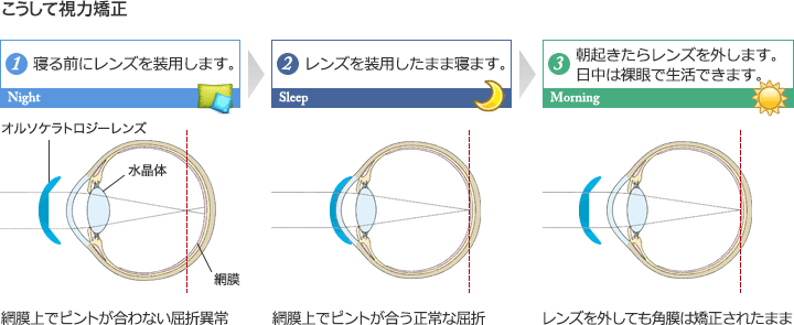 1.寝る前にレンズを装用します。 2.レンズを装用したまま寝ます。 3.朝起きたらレンズを外します。日中は裸眼で生活できます