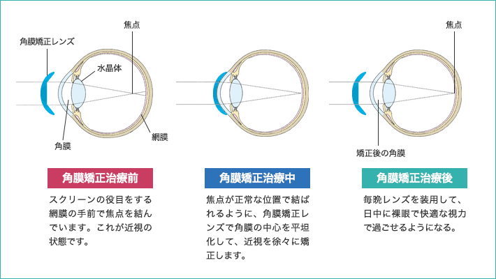 角膜矯正治療前 角膜矯正治療中 角膜矯正治療後